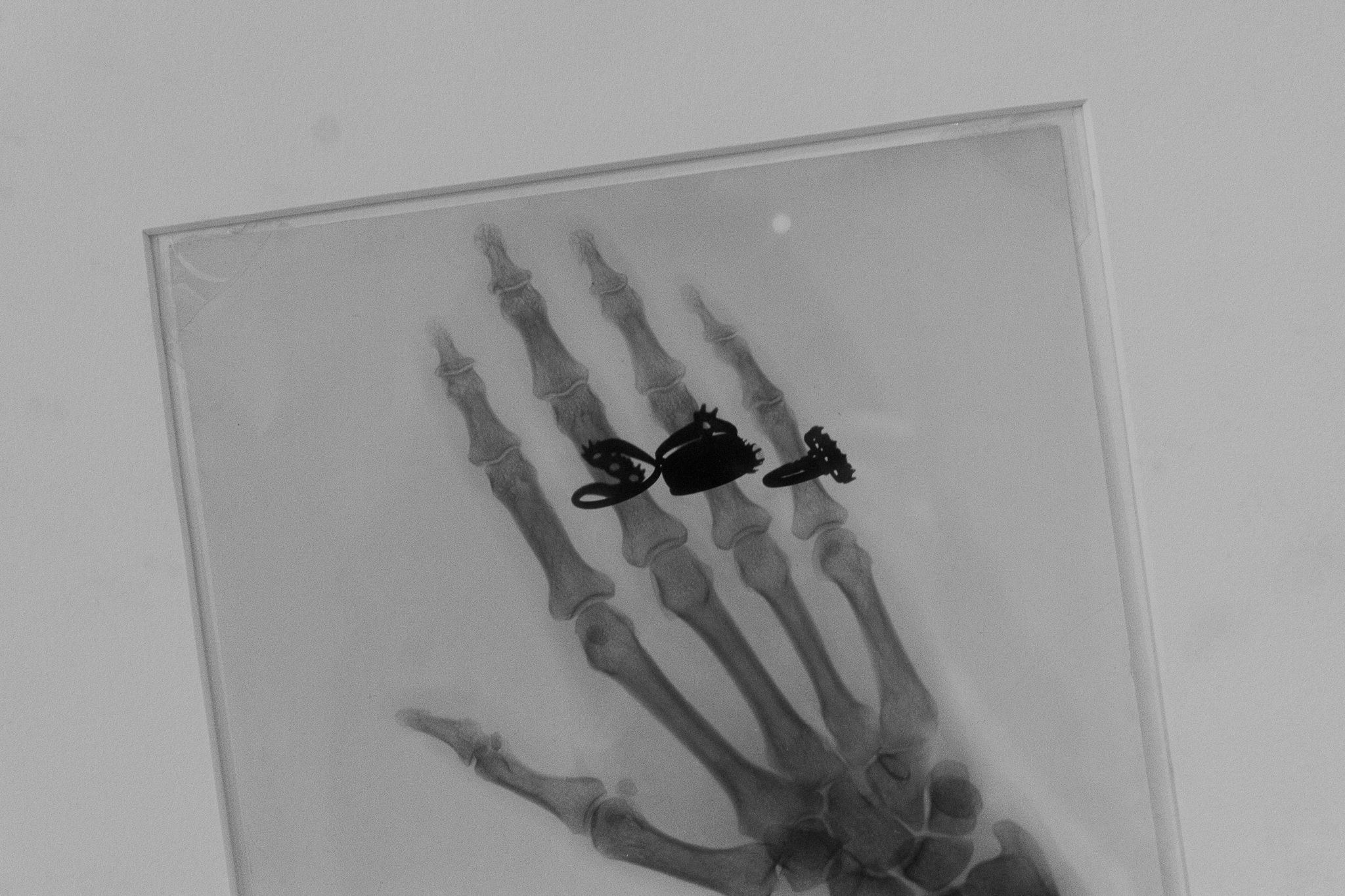 X-ray image of a human hand with rings on the fingers